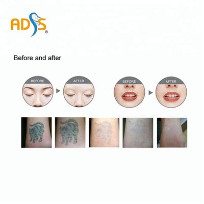 Vertikale Nd Yag Laser-Maschinen-Laser-Haar-Abbau-und Tätowierungs-Abbau-Maschine ISO13485